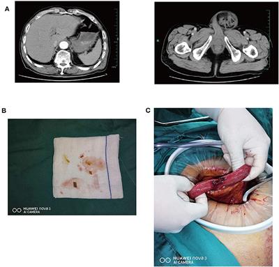 Small Bowel Perforation Due to Blunt Trauma of Left Leg With an Incarcerated Inguinal Hernia: A Case Report
